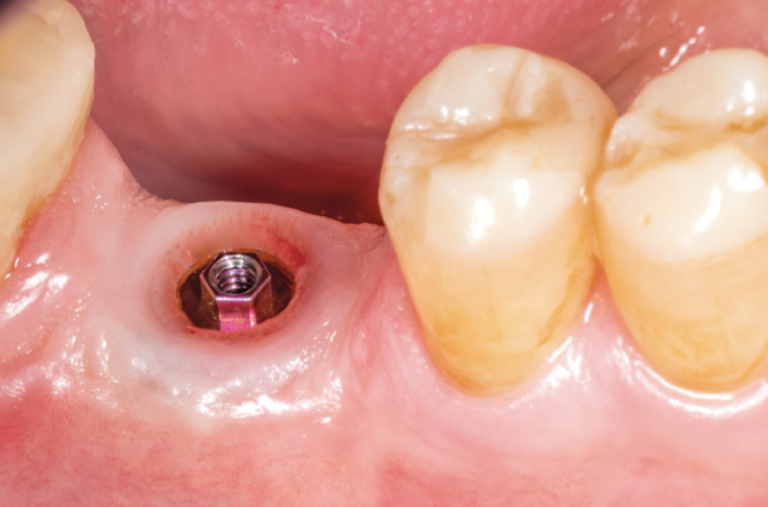 Corona Individual En Composite Sobre Implante XCN Y ExaConnect Casos