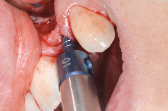 Treatment Of Bilateral Agenesis Of Upper Lateral Incisors With Narrow