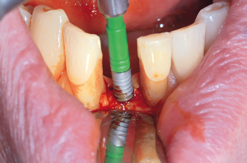 Dalla Cina arrivano i denti finti che funzionano anche da apparecchio  acustico