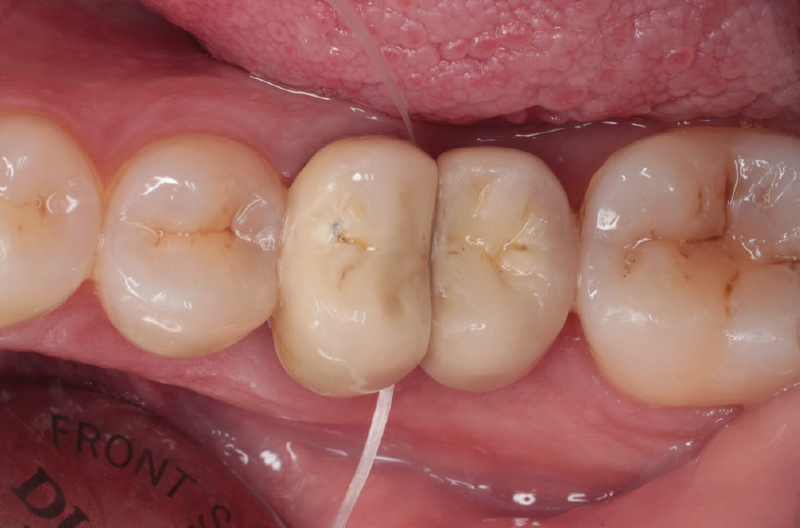 KQNM 12 Pezzi Allineatore Dentale di Strumenti di Rimozione